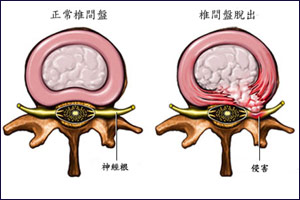 <b>治疗椎间盘突出的三个瑜伽方法</b>