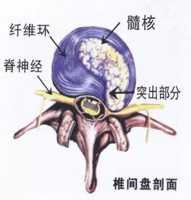 <b>瑜伽如何帮你预防腰间盘突出？</b>